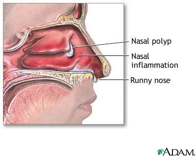 Nasal Polyp